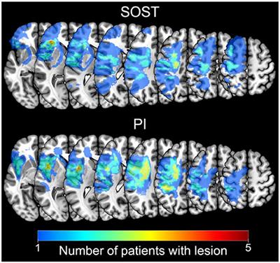 Behavioral and Neural Correlates of Cognitive Training and Transfer Effects in Stroke Patients